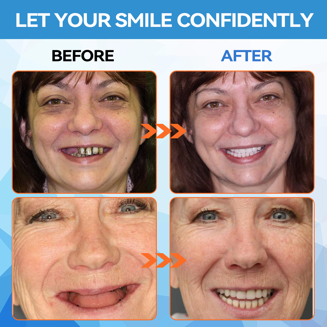 Official Store |Minceetbien™🗽 Moldable Dentures(⏰Limited Time 80% Off - Last 30 Minutes ⏰)